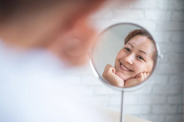 Uma mulher com vitiligo olha no espelho. Reflexão em uma mesa espelhar uma menina com um ponto branco na testa. Doença auto-imune. Falta de pigmentação da pele. — Fotografia de Stock