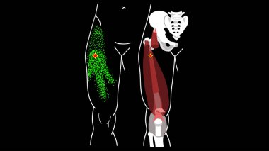 Vastus Intermedius Tetik Noktası. Bacak ağrısı. Sürüm