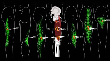 Vastus Lateralis Tetik Noktaları. Bacak ağrısı. Sürüm