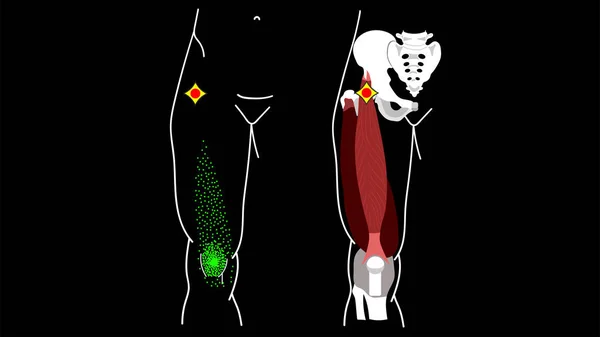 Punto desencadenante Rectus femoris muscular Dolor en las piernas — Archivo Imágenes Vectoriales