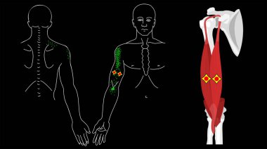 Musculus biceps brachii. Biceps trigger points and pain clipart