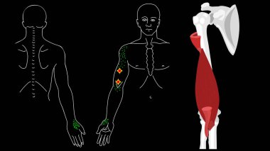 Brachialis muscle. Trigger points in the arm clipart