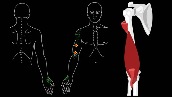 Brachialis muskler. Trigger punkter i armen — Stock vektor