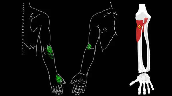 Supinator Muskel. Triggerpunkte in den Muskeln der Hände. — Stockvektor