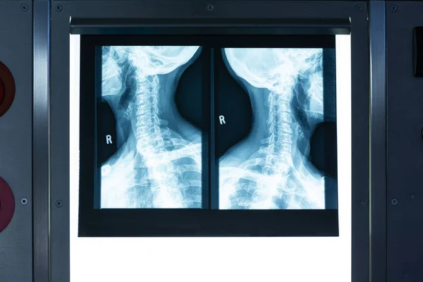 Nahaufnahme Eines Röntgenhalses Einem Leuchtkasten Operationssaal Des Krankenhauses — Stockfoto