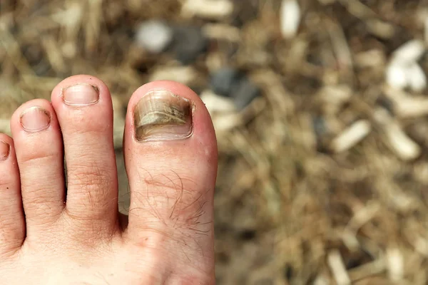 Close Hairy Human Foot Toes Cracked Black Bruised Toe Nail — Stock Photo, Image