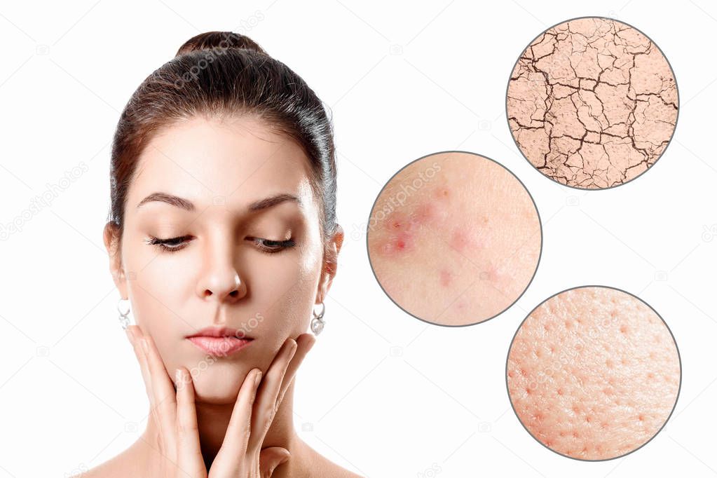Young woman with acne, dry skin, black dots skin in zoom circle . Skin care concept. Young girl, beauty portrait. Close-up.