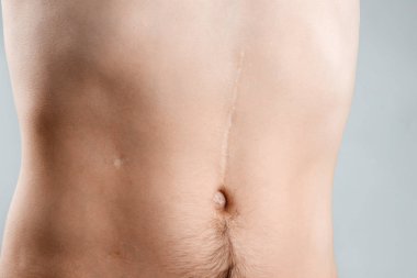 scars removal concept, large scar after surgery on the abdomen young man, blurred neutral background, selective focus clipart