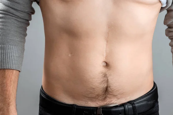 Scars Removal Concept Large Scar Surgery Abdomen Young Man Blurred — 스톡 사진