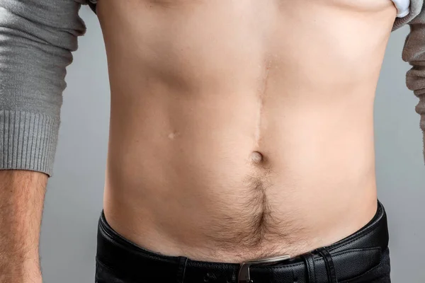 Concepto Eliminación Cicatrices Cicatriz Grande Después Cirugía Abdomen Joven Fondo — Foto de Stock