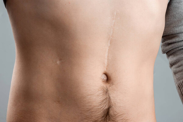 scars removal concept, large scar after surgery on the abdomen young man, blurred neutral background, selective focus
