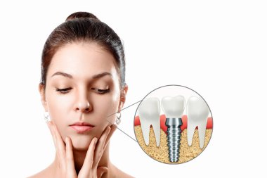 Güzel bir kız portresi, diş implantı, paslanmaz iğne. Tıp konsepti, yeni teknolojiler, diş protezleri, kopyalama alanı