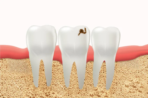 Изображение Зуба Кариесом Медицинская Концепция Новые Технологии Уход Полостью Рта — стоковое фото