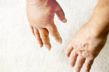 bir çift el aşağı bakıyor, ve bunlardan biri bir hornet sting.close nedeniyle şişmiş.