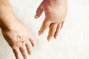 bir çift el aşağı bakıyor, ve bunlardan biri bir hornet sting.close nedeniyle şişmiş.