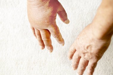 bir çift el aşağı bakıyor, ve bunlardan biri bir hornet sting.close nedeniyle şişmiş.