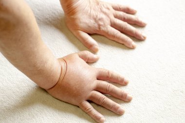 bir çift el aşağı bakıyor, ve bunlardan biri bir hornet sting.close nedeniyle şişmiş.