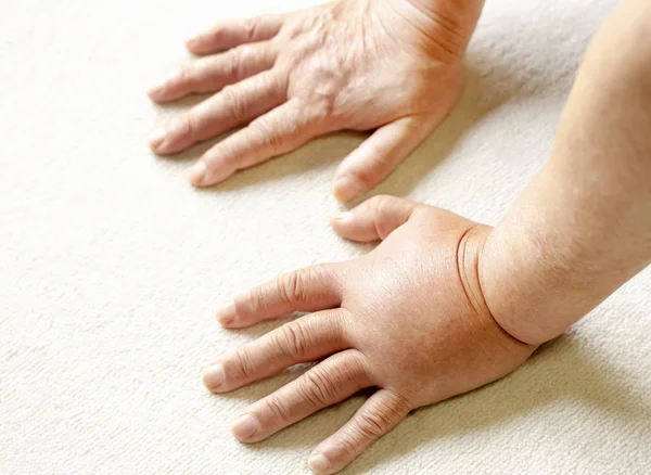 Olhando Para Baixo Par Mãos Uma Das Quais Está Inchada — Fotografia de Stock