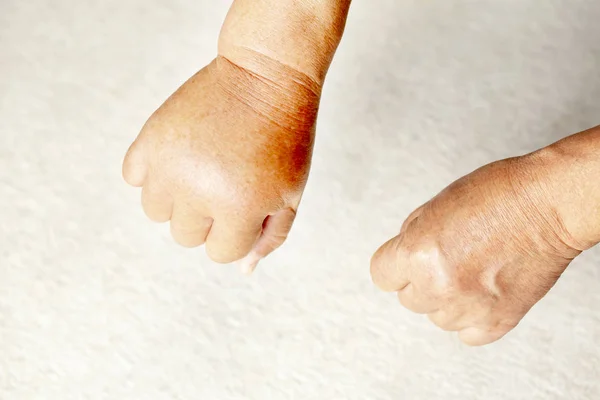 Neer Kijken Een Paar Handen Waarvan Één Gezwollen Als Gevolg — Stockfoto