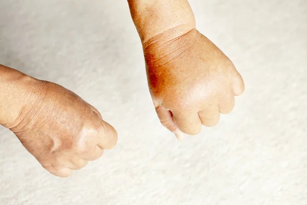 looking down on a pair of hands, one of which is swollen due to a hornet sting.close up.