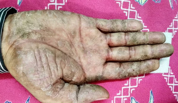 Хвороба псоріазу на руці людини. Жорстка, тріснута шкіра на внутрішній стороні чоловічої руки. Тріснута, луската шкіра на долоні. дерматологічні проблеми псоріазу . — стокове фото