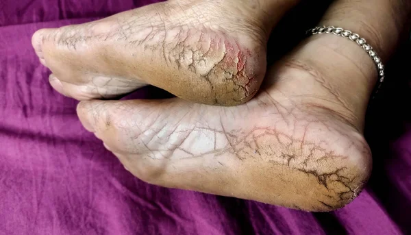 Yüksek çözünürlüklü yakın çekim görüntüsü kuru, çatlak topuklar ve çıplak ayak tabanları, cilt dokusu ve ayak bakımı sorunları vurgulanıyor.