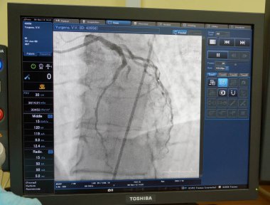 Moskova, Rusya - 09 Kasım 2012: X-ray görüntü izleme ile ilgili hastanın gemilerin. Moskova şehir klinik hastanede endovasküler ameliyat odasında.