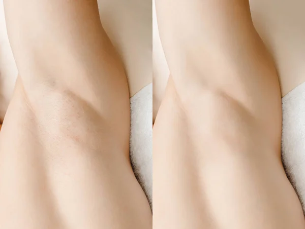 Antes e depois da depilação masculina tratamento do procedimento de depilação a laser — Fotografia de Stock