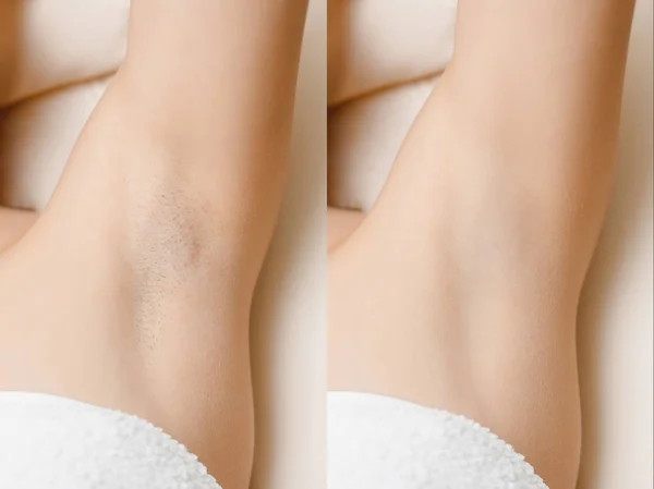 Women underarm hair removal before and after — Stock Photo, Image