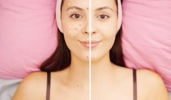 Before and after acne treatment procedure woman face. Concept skin care spa