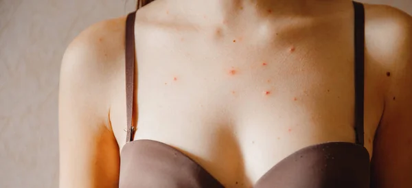 Detailní záběr kůže dospělé ženy postižené planými neštovicemi, akné a dermatologií — Stock fotografie