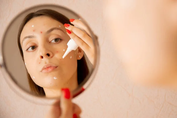 Wanita muda Kaukasia menerapkan krim terhadap jerawat dan cacar air di wajahnya, melihat di cermin — Stok Foto
