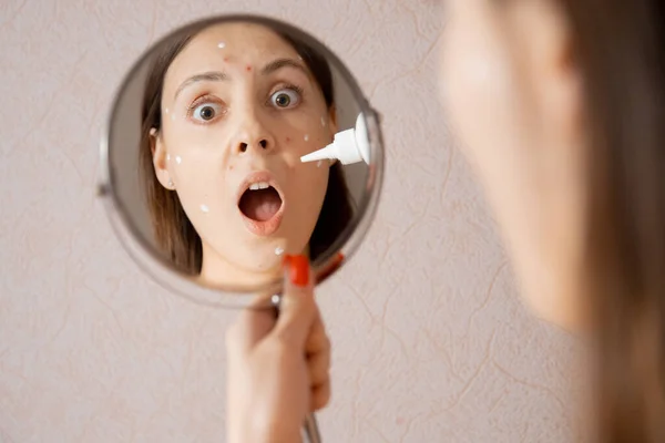 Young caucasian woman is applying cream against acne and chicken pox on her face, looking in mirror — Stock Photo, Image