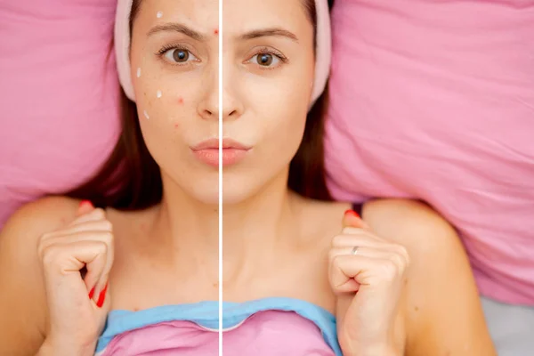 Sebelum dan sesudah perawatan jerawat wanita prosedur wajah. Konsep spa perawatan kulit — Stok Foto