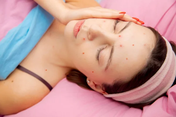 Wanita muda dengan virus cacar air varicella, dengan wajah sedih di tempat tidur — Stok Foto