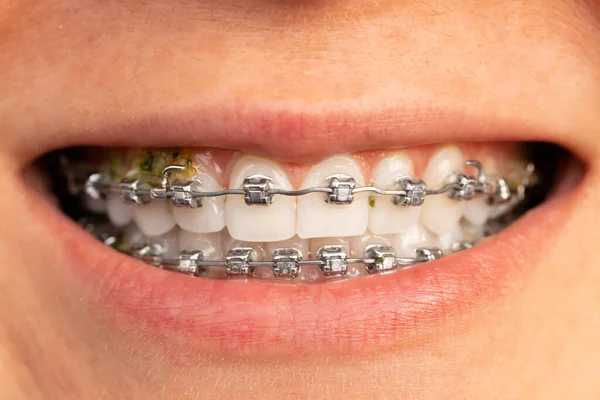 Problem of cleaning dental metal braces from food debris and dirt