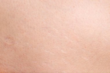 Olgun kadın tenine selülit yakın çekim