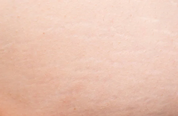 Celulitis Primer Plano Piel Mujer Madura —  Fotos de Stock