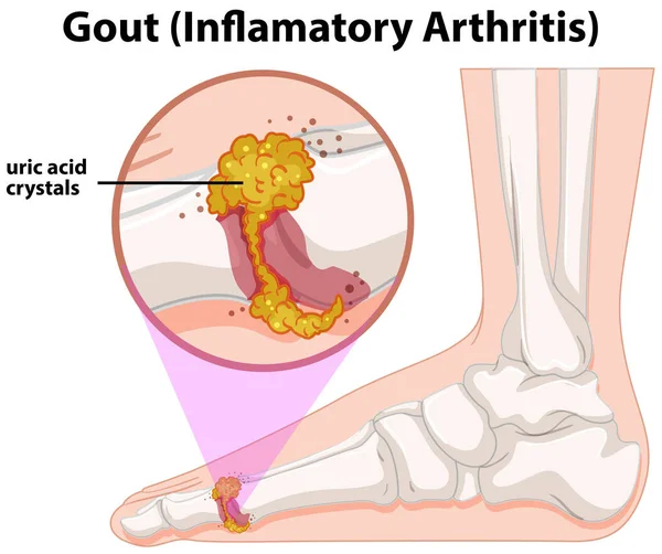 Medical Human Anatomy Gout Illustration — Stock Vector