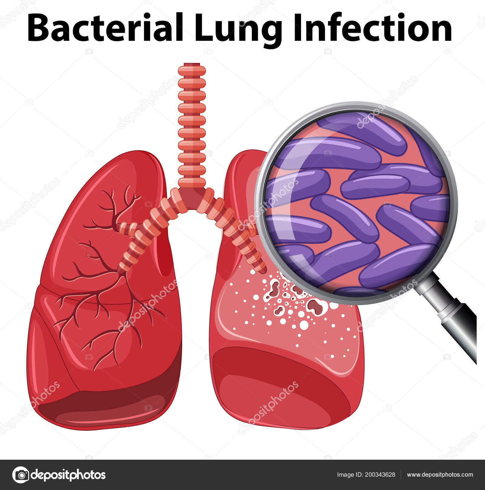 Bacterial Lung Infection White Background Illustration Stock Vector