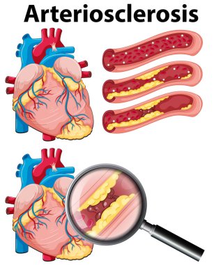A Heart with Arteriosclerosis on White Background illustration clipart