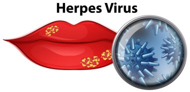 Herpes virüsü çizim ile bir dudak