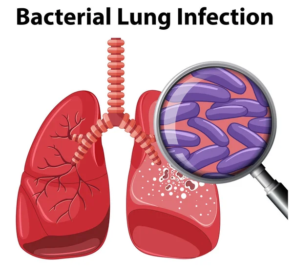 Bacterial Lung Infection White Background Illustration — Stock Vector