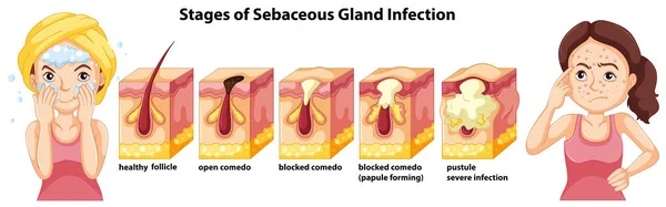 Illustrazione Delle Fasi Infezione Della Ghiandola Sebacea — Vettoriale Stock