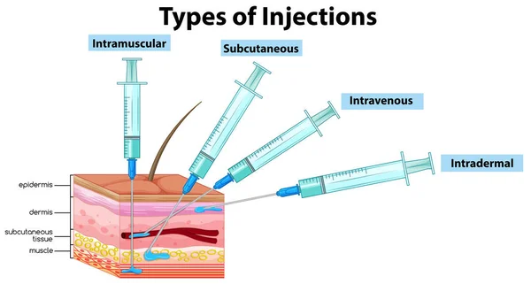 Arten Von Injektionen Auf Weißem Hintergrund Illustration — Stockvektor