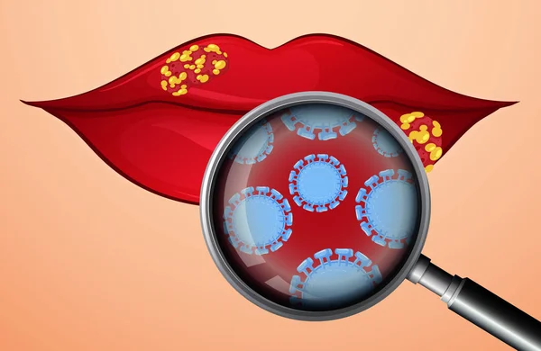 Een Lip Met Herpes Virus Illustratie — Stockvector