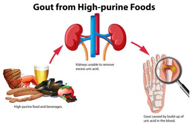 Gout from High-purine Foods illustration clipart