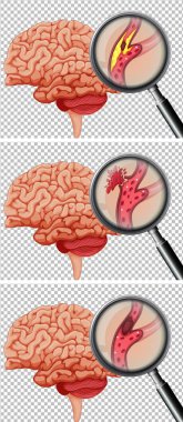 A Set of Human Brain With Stroke illustration clipart