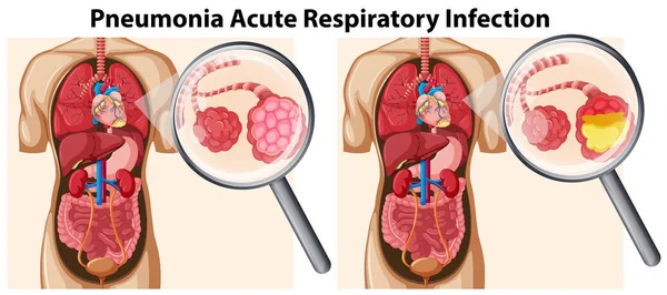 Longontsteking Acute Respiratoire Infectie Illustratie — Stockvector