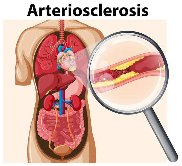 Corpo Humano Com Ilustração Arteriosclerose —  Vetores de Stock